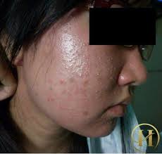 Cảnh báo thị trường kem trộn làm trắng da trôi nổi