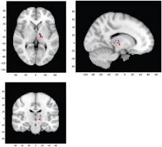 Image result for Thalamotomy