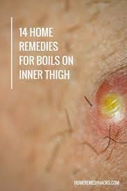 14 Proven Home Remedies For Boils On Inner Thigh Home Remedy For Boils Home Remedies Inner Thigh