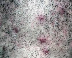 Constant shaving (no matter, face or legs) necessarily leads to the formation of ingrown hairs. Ingrown Hair Ingrown Hair On Head Causes