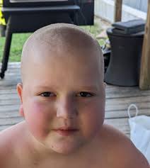 Dealing with hair loss and considering baldness