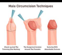 Image result for paraphimosis