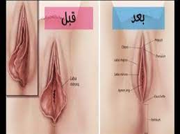 تضييق المهبل بعد الولادة والتخلص من الرائحة الكريهة الشبة لتضييق المهبل و تحسين رائحته youtube