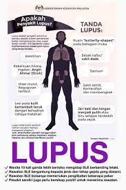 Tahapan ini merupakan tahapan yang paling menular.pengidap akan merasakan gangguan serius pada pembuluh darah dan jantung. Apa Itu Sistemik Lupus Eritematosus Klinik Putramedic Facebook