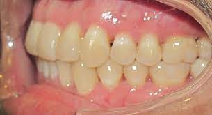 After getting your braces on, it can take as little as a few months to several years for your braces to gently pressure your. How Long Do Braces Take How Long Do Braces Take