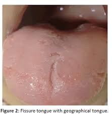 Image result for Fissured tongue
