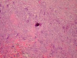 Mesothelioma is a neoplasm arising from mesothelial cells that line serous cavities, such as the pleura and peritoneum pleural mesothelioma is much more common than peritoneal mesothelioma epithelioid mesothelioma is the most frequent histologic type of malignant mesothelioma; Pathology Outlines Mesothelioma
