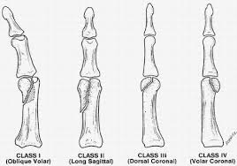 Image result for Volar PIP Dislocation