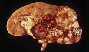 Types of bladder cancer are named for the type of cells that become cancerous. Kidney Cancer Germany Pdf Ppt Case Reports Symptoms Treatment