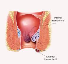 Medical diagram illustrating internal and external hemorrhoids in the rectum