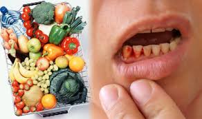 SCURVY ALERT: Disease makes COMEBACK in West due to poor diet ...