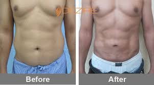 Stomach Liposuction Cost In Delhi India Abdo 3 D Vaser Lipo Abdominoplasty Tummy Tuck Surgery Liposuction Cost