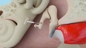Stapedotomy To Treat Otosclerosis Surgery Ear Ear Anatomy