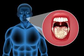 Image result for gum cancer symptoms