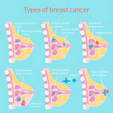 After skin cancer, breast cancer is the most common type of cancer diagnosed in women. Breast Cancer Dr Erick Fuentes Oncoplastic Breast Surgeon