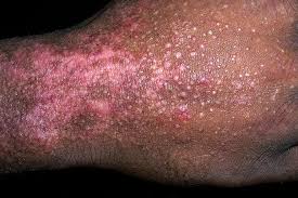 Image result for dermatitis contacta children
