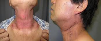 Image result for Radiation Dermatitis