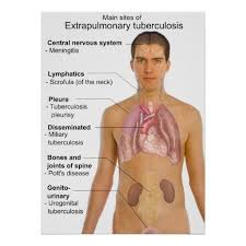 Image result for Extrapulmonary Tuberculosis