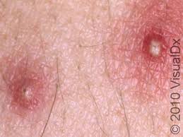 Image result for folliculitis symptoms