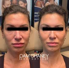 Bellafill is a long-lasting dermal filler designed to smooth wrinkles,  lift, and contour the face. Unlike temporary fillers, Bellafill is made of  tiny, smooth collagen beads that provide immediate volume and help