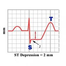 Image result for Electrocardiogram Validity