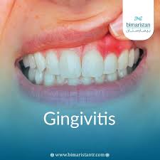 Image result for Gingivitis