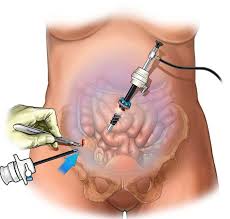 Endoscopy – Fibroid Care and Removal ...