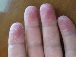 A Blog Is About Health Fitness And Beauty Tips Homemade Natural Fairness Masks Health And Beauty Benefits Of Peeling Fingertips Peeling Skin Hand Dermatitis