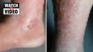 Maybe you would like to learn more about one of these? Dementia Patient S Maggot Infested Wounds Discovered During Xmas Visit