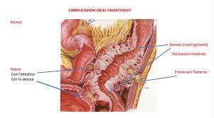 Patogenesi, fattori di rischio e trattamento. Diverticolite Del Colon Chirurgia Laparoscopica