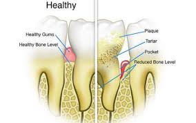 Help prevent tooth decay & future dental work. How To Get Rid Of Tartar On Teeth At Home Teethwalls