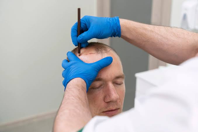 What Makes DHI Hair Transplant in Abu Dhabi a Preferred Choice