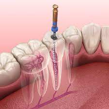 How To Avoid A Root Canal Implant Dentistry Aesthetic Dentistry Root Canal