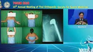 Dia tmbuh d keluarga kelas menengah dari seorang ayah bernama haris dan ibu brnama nia. Hemi Or Rtsa Is The Best For Proximal Humeral Fracture Youtube