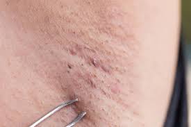 The rate of growth will, however, vary from one person to the other. Ingrown Armpit Hair Cyst Ingrown Hair Remedies Armpit Cyst Ingrown Hair Bump