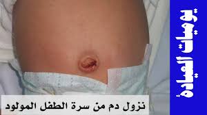 نزول دم من سرة المولود والعناية بالسرة يوميات العيادة Youtube