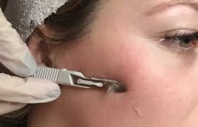 Ingrown hairs are a pesky skin problem that occur after shaving, plucking, tweezing, threading, or waxing hair. 9 Ways To Remove White Facial Hair At Home And Salon Treatments