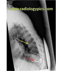 Image result for Vertebral Compression Fracture