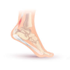 Your achilles tendon can develop tendonitis. Achilles Tendinitis Wikipedia