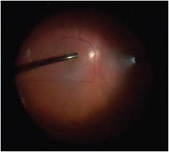 The majority of retinal breaks, holes, or tears are spontaneous, result when the vitreous gel pulls loose or separates from its attachment to the retina, usually in the peripheral parts of the retina. Retinal Physician Traumatic Retinal Detachment In Younger Patients