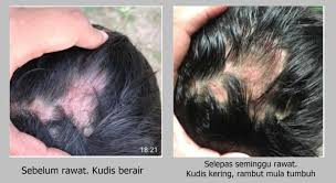 Penyakit kulit hypohidrosis atau disebut (anhidrosis) yakni jenis penyakit kulit langka, karena penderita tidak mampu berkeringat secara normal, penyakit ini sanagatlah berbahaya yang berakibat buruk bagi. Kepala Berkudis Berair Kini Mudah Dirawat Psherbs Testimoni