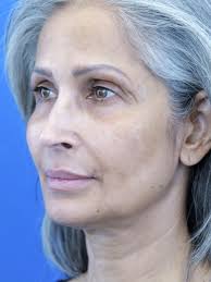 Cases in Facelift Deep Plane