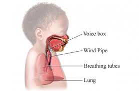 Croup Cough Medico Reporter