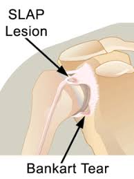 Image result for SLAP Lesion