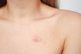 Image result for Candidiasis under breasts