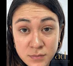 Toxina Botulínica en Bogotá