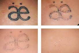 Nice Home Remedies For Tattoo Removal Natural Ways To Remove Fade Lighten Tattoo At Home At Home Tattoo Removal Tattoo Removal Cost Tattoo Removal Cream