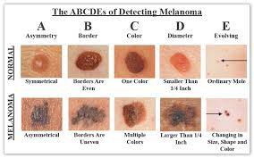 How prevalent is skin cancer? Getting To Know Skin Cancer Extrashade