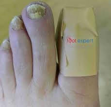 Image result for Clubbing nails feet