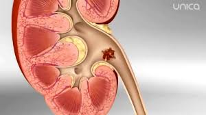 Litotripsia are o eficienta mare. Litotripsia Procedura Care Te ScapÄ De Pietrele La Rinichi Mai Eficient Decat Ceaiurile Diuretice Youtube